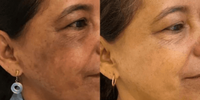 Melasma