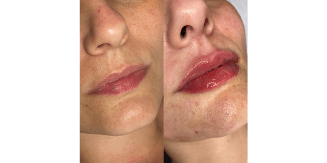 Preenchimento Labial