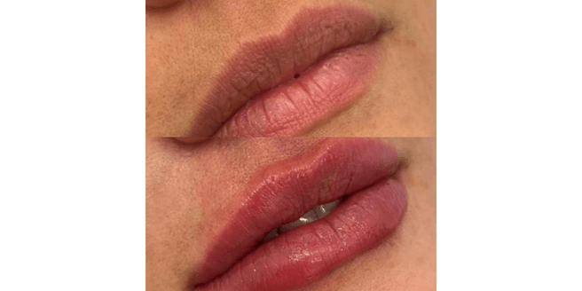 Preenchimento Labial